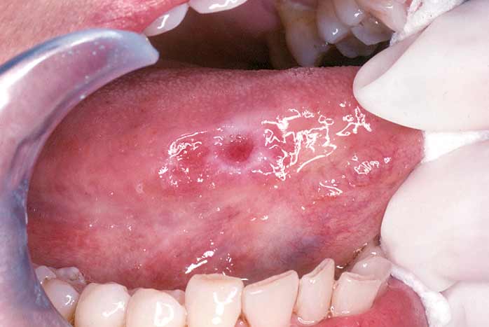 Oral Cancer Screening