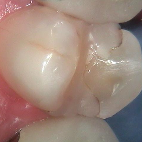 Cracked tooth photo