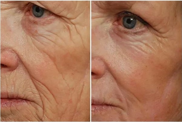 Laser peel