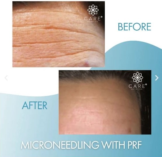 Microneedling